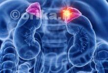 بیماری کورتیزول