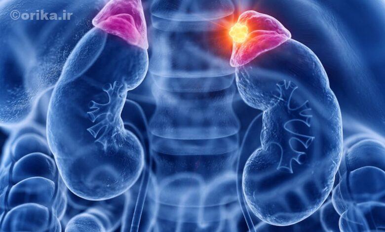 بیماری کورتیزول