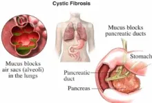 فیبروز کیستیک (CF) چیست؟ شناخت کامل بیماری، علائم و درمان نوین ژنتیکی