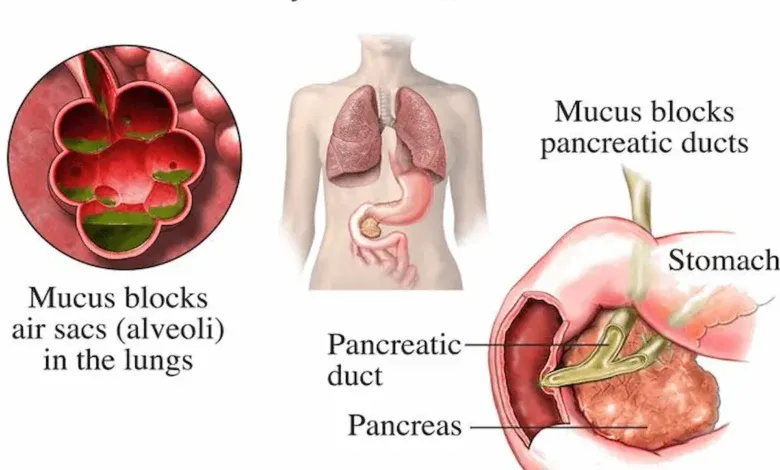 فیبروز کیستیک (CF) چیست؟ شناخت کامل بیماری، علائم و درمان نوین ژنتیکی