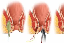 فیستول مقعدی در زنان