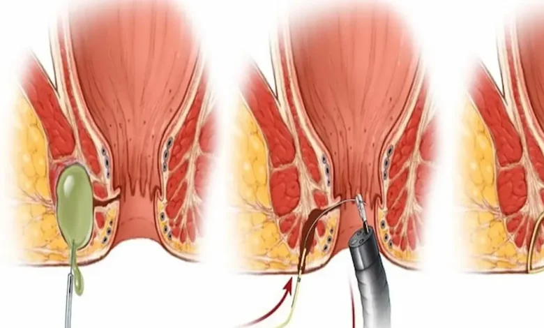 فیستول مقعدی در زنان