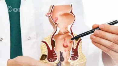 درمان بواسیر