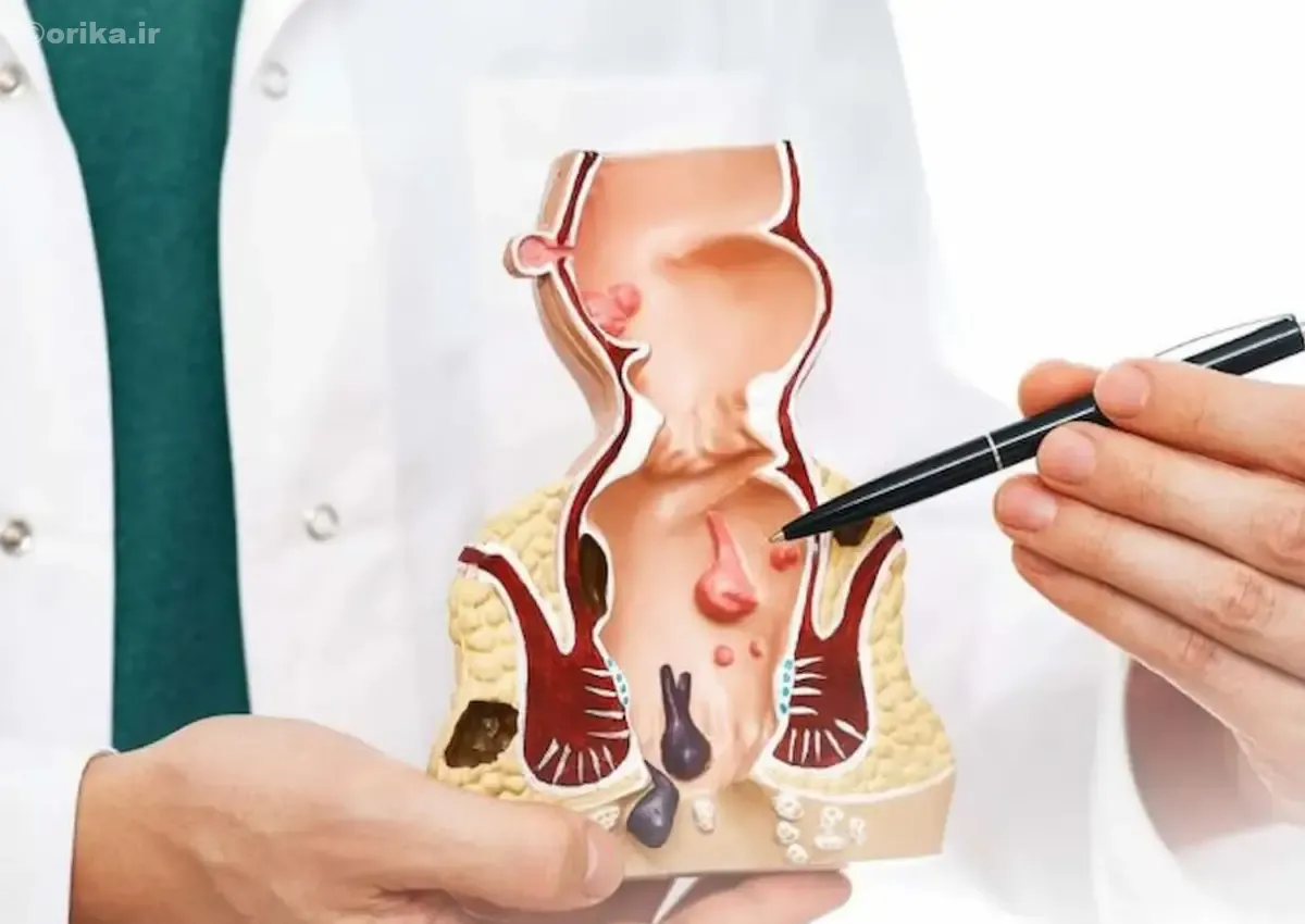 درمان بواسیر