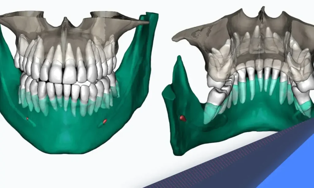 ایمپلنت چانه با طراحی اسکن سه‌بعدی