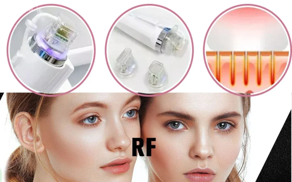 کانتور بینی بدون جراحی با RF