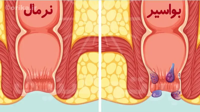 درمان بواسیر چیست