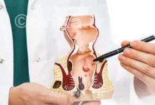 درمان بواسیر