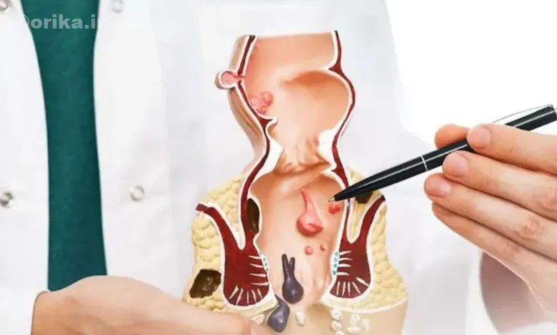 درمان بواسیر