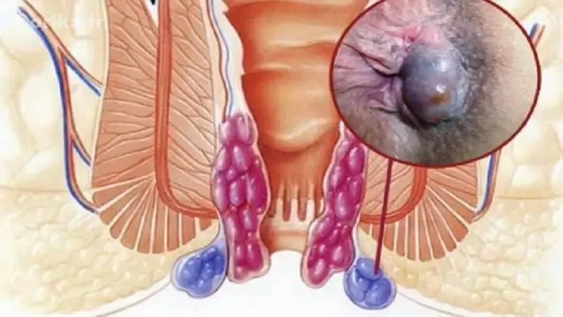 درمان دارویی بواسیر