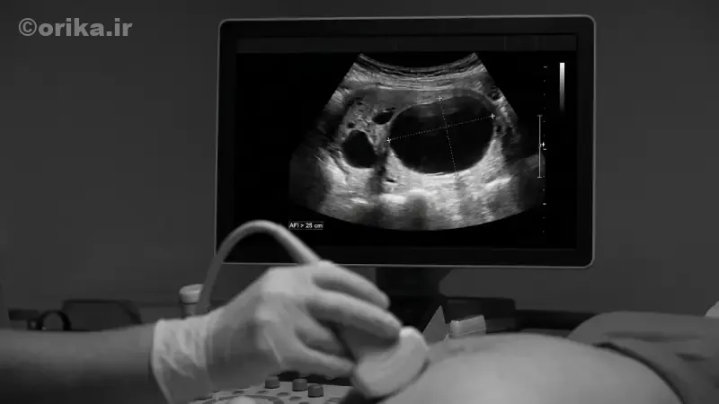 عوارض افزایش مایع آمنیوتیک برای جنین
