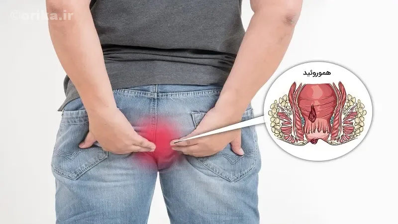 پیشگیری از بواسیر