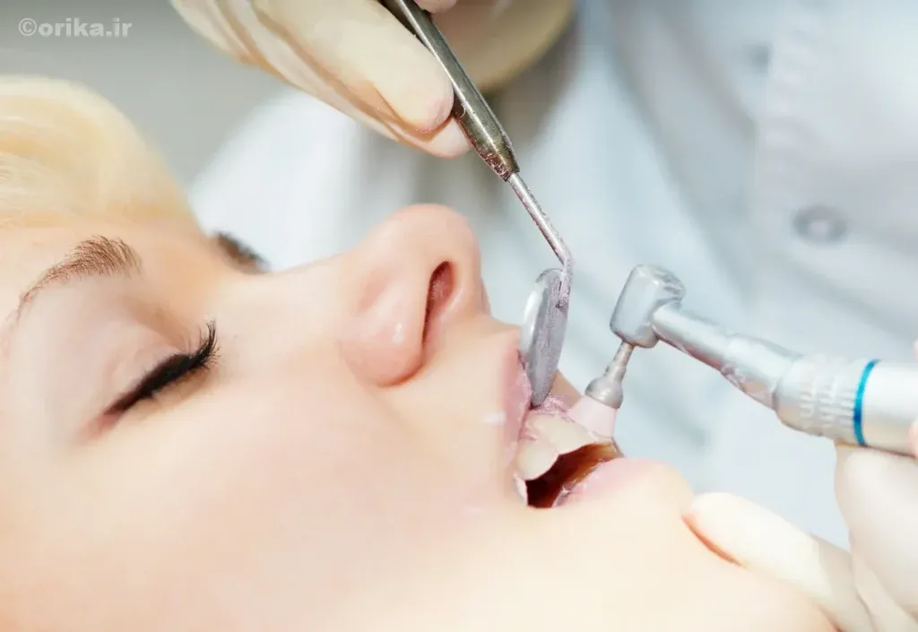 باورهای اشتباه درباره جرم گیری دندان