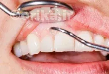 جرم گیری دندان