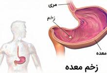 همه چیز درباره زخم معده