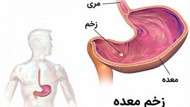 همه چیز درباره زخم معده